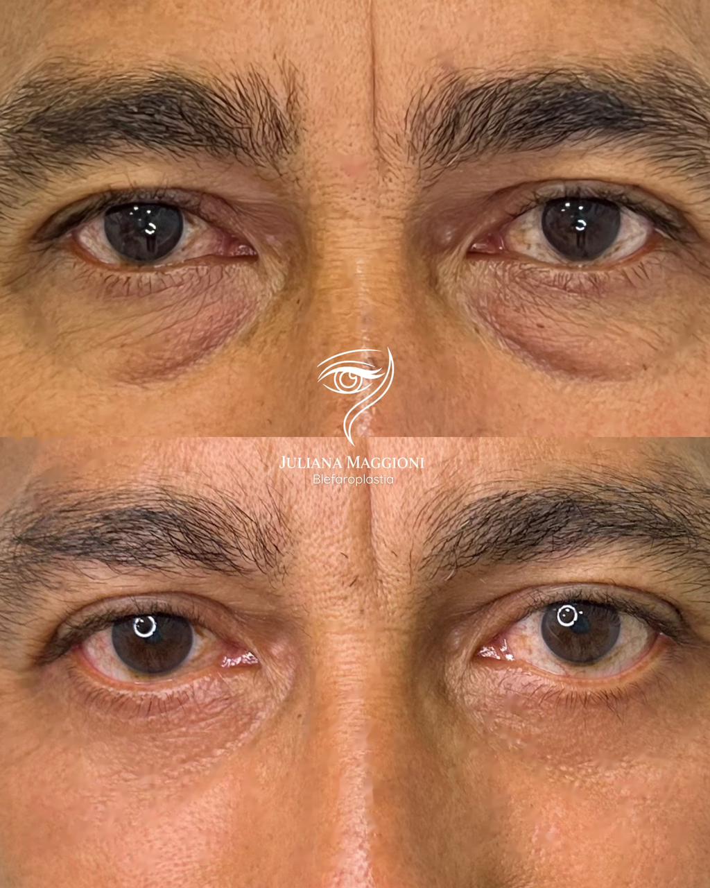 Resultado blefaroplastia inferior – Dra. Juliana Maggioni Dois Vizinhos
